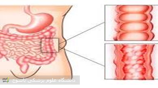 تغذیه-در-بیماری-های-التهابی-روده-